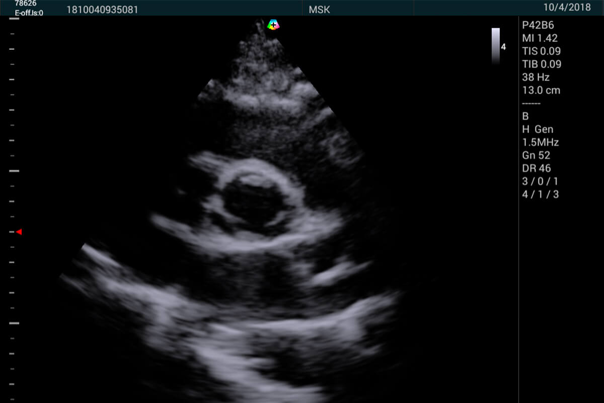 T3300_application_Parasternal_Short_Axis_View_Aortic_Valve_Level_09